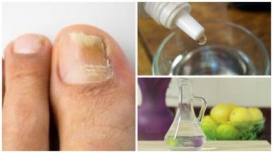 Hausmittel gegen Nagelpilz selbst herstellen