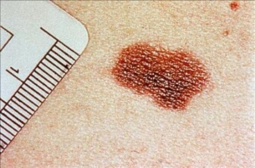 Die häufigsten Hautkrankheiten: Hautkrebs