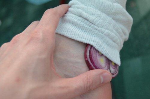 Schwielen mit Zwiebel behandeln