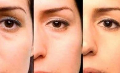 Tipps zur Behandlung von Tränensäcken