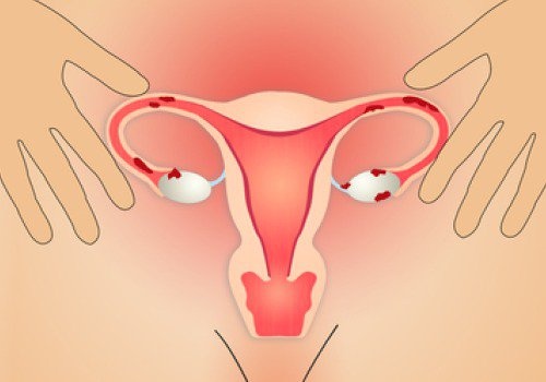 Weibliche Geschlechtsorgane, Blutgerinnsel in der Menstruation