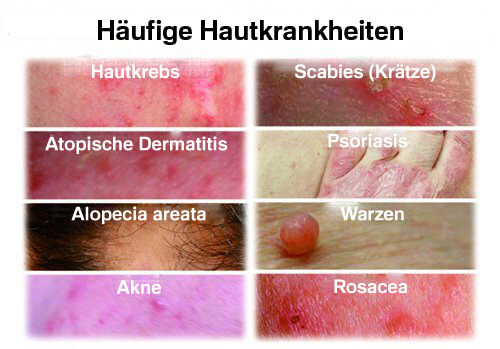 Die häufigsten Hautkrankheiten