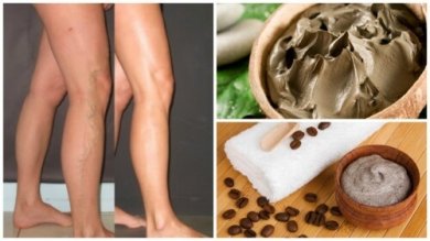 5 Naturmittel gegen Krampfadern