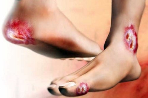 Fuß durch Diabetes geschädigt