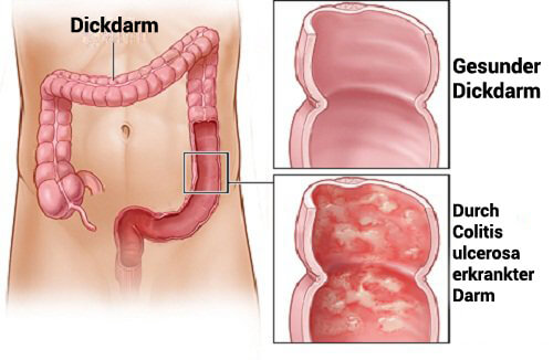Colitis Ulcerosa: chronisch kranker Darm