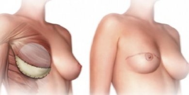 Was solltest du über eine Brustamputation wissen?