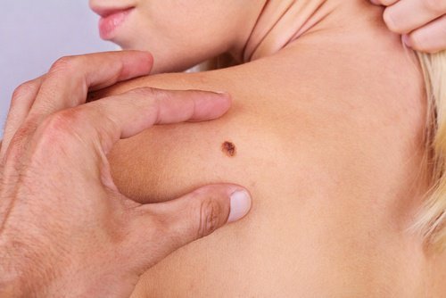 7 Dinge über Hautkrebs, die jeder wissen sollte