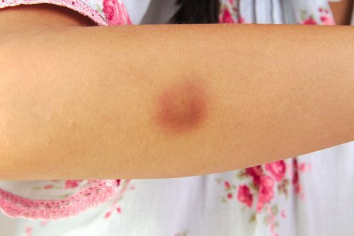bluterguss-am-arm-vicks-vapoRub