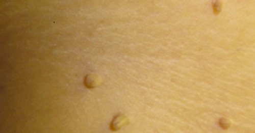 warzen-entfernen-vicks-vapoRub