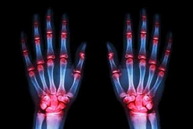 Wie kann man Arthrose behandeln?