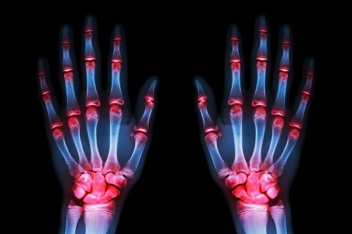 Wie kann man Arthrose behandeln? - Besser Gesund Leben