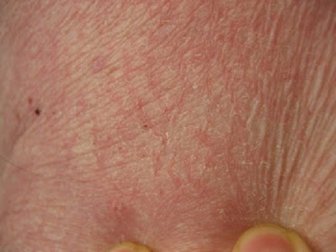 5 Rezepte gegen trockene Haut an verschiedenen Körperbereichen