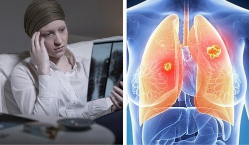 Lungenkrebs bei Frauen tödlicher