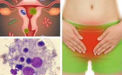 6 Tipps gegen eine Pilzinfektion im Intimbereich