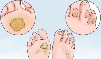 10 Heilmittel gegen Schwielen und Blasen