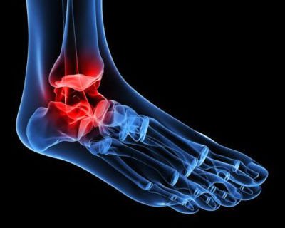 Arthrose im Knöchel: stiller Schmerz bei jedem Schritt