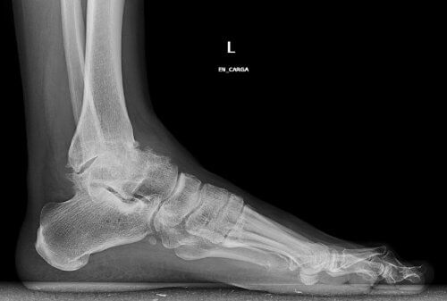 Röntgenbild von Arthrose im Knöchel