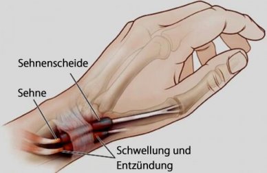 Sehnenscheidenentzündung an Händen oder Füßen