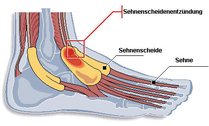 sehnenscheidenentzuendung