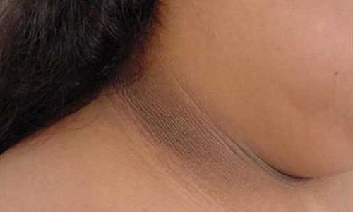 4 Methoden gegen dunkle Hautflecken am Hals