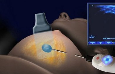 Kryoablation: eiskalt gegen Brustkrebs