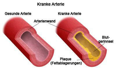 kranke-arterie