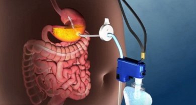 Morbide Adipositas: neue Behandlung ohne Operation