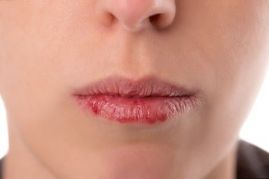 Oropharynxkarzinom: Symptome, die jeder kennen sollte