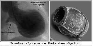 broken-heart-syndrom-oder-liebeskummer