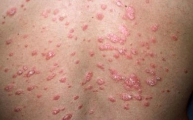 Arten von Schuppenflechte (Psoriasis)