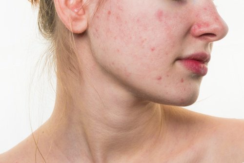 5-ernaehrungsgewohnheiten-die-deine-gesichtshaut-ruinieren-koennen 5-ernaehrungsgewohnheiten-die-deine-gesichtshaut-ruinieren-koennen
