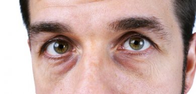Augenringe bei Frauen: natürlich entfernen