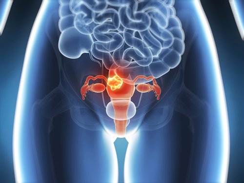 Gebärmutter-Myom: Arten, Ursachen, Risiken und Symptome