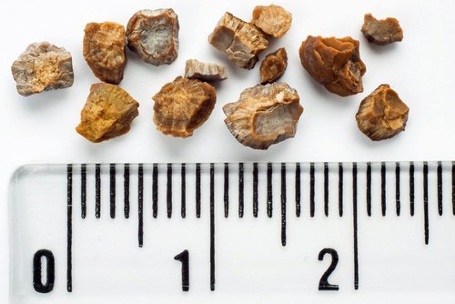 nierensteine-mit-loewenzahn-behandeln