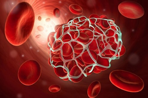 Wie kann man Thrombosen vorbeugen?