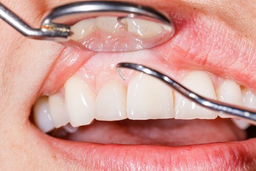 7 Lösungen gegen entzündetes Zahnfleisch