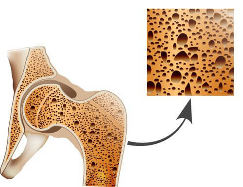 Naturheilmittel gegen Osteoporose