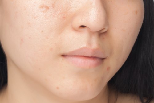 7 Ernährungsgewohnheiten, die deiner Gesichtshaut schaden
