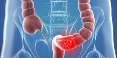 9 Naturmittel zur unterstützenden Behandlung von Darmkrebs