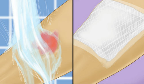 Erste Hilfe für leichte Verbrennungen durch heißes Wasser