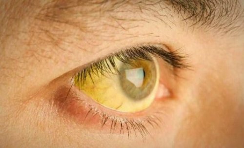 Gelblich verfärbte Lederhaut des Auges