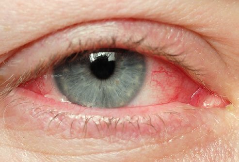 rotes Auge