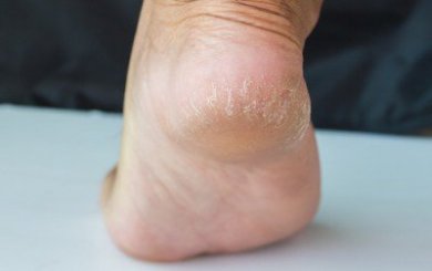 6 Heilmittel gegen Hornhaut an den Fersen