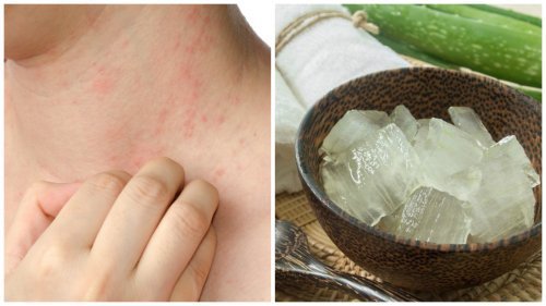 aloe gegen hitzeallergie