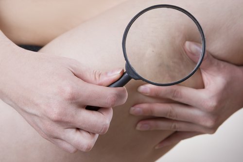 Frau untersucht Cellulite