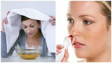 7 wirksame Hausmittel gegen Nasenbluten