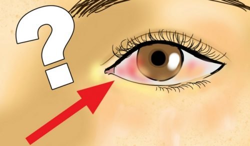 Netzhautablösung: Ursachen und Vorsorge