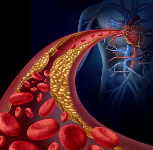 Atherosklerose Komplikationen