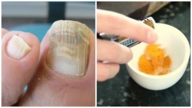 Nagelpilz könnte man mit Kurkuma behandeln