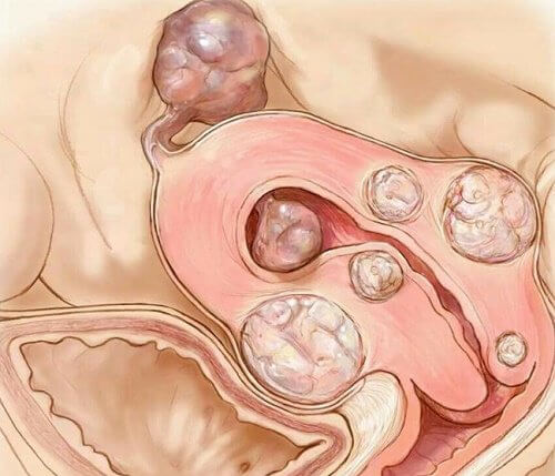 Uterusmyom